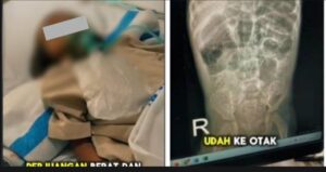 Kisah Pilu Bocah 3 Tahun di Sukabumi, Tubuh Dipenuhi Cacing hingga Meninggal Dunia